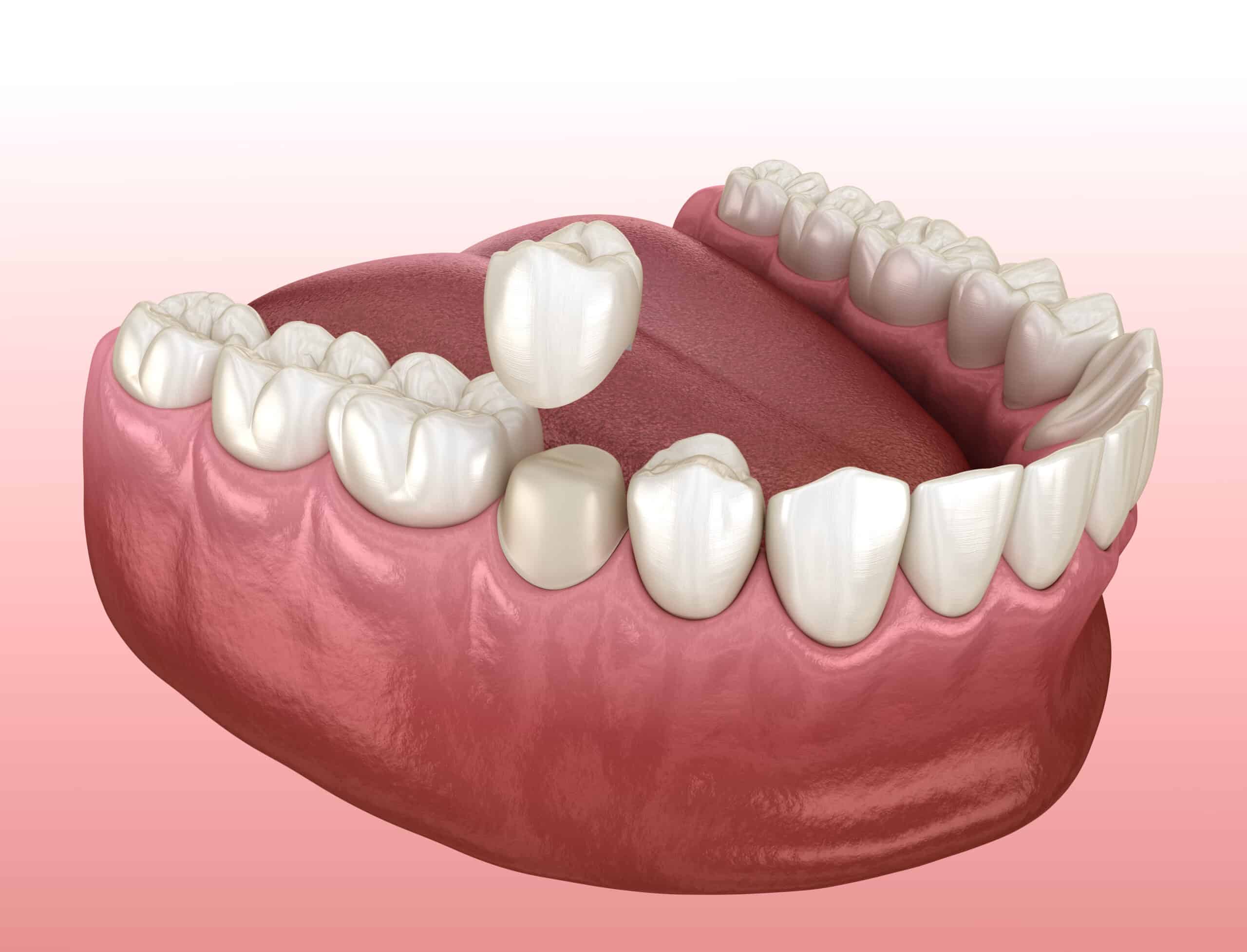 What Is Considered Major Restorative Dental Services