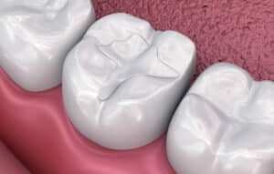 dental fillings denver
