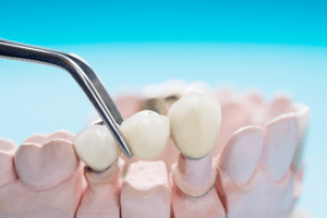 Dental Bridges VS Dental Implants - What's The Difference? aspen dental dentist in cherry creek denver co