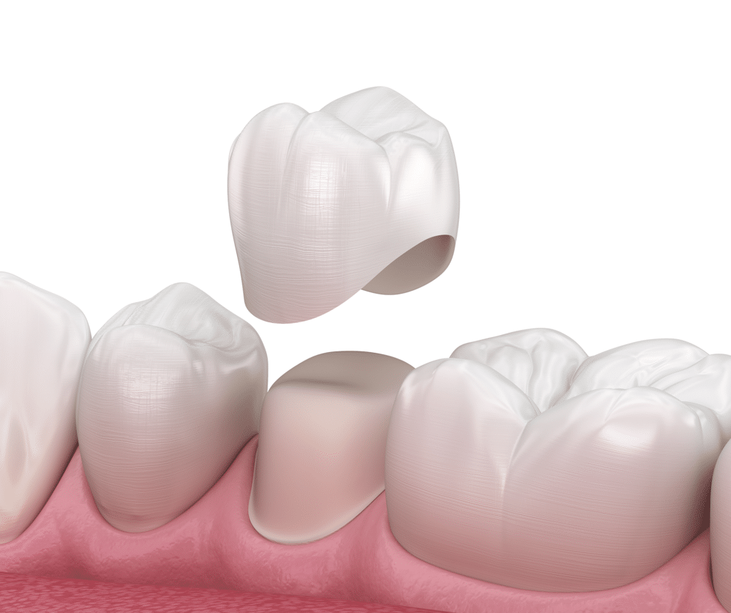 How Much Is A Crown At Aspen Dental Dental Crowns Denver | Aspen Dental | Dentist CO 80206
